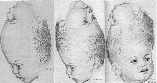 Craniopagus surgical procedure